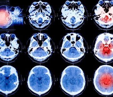 Human hormone may help brain injury victims